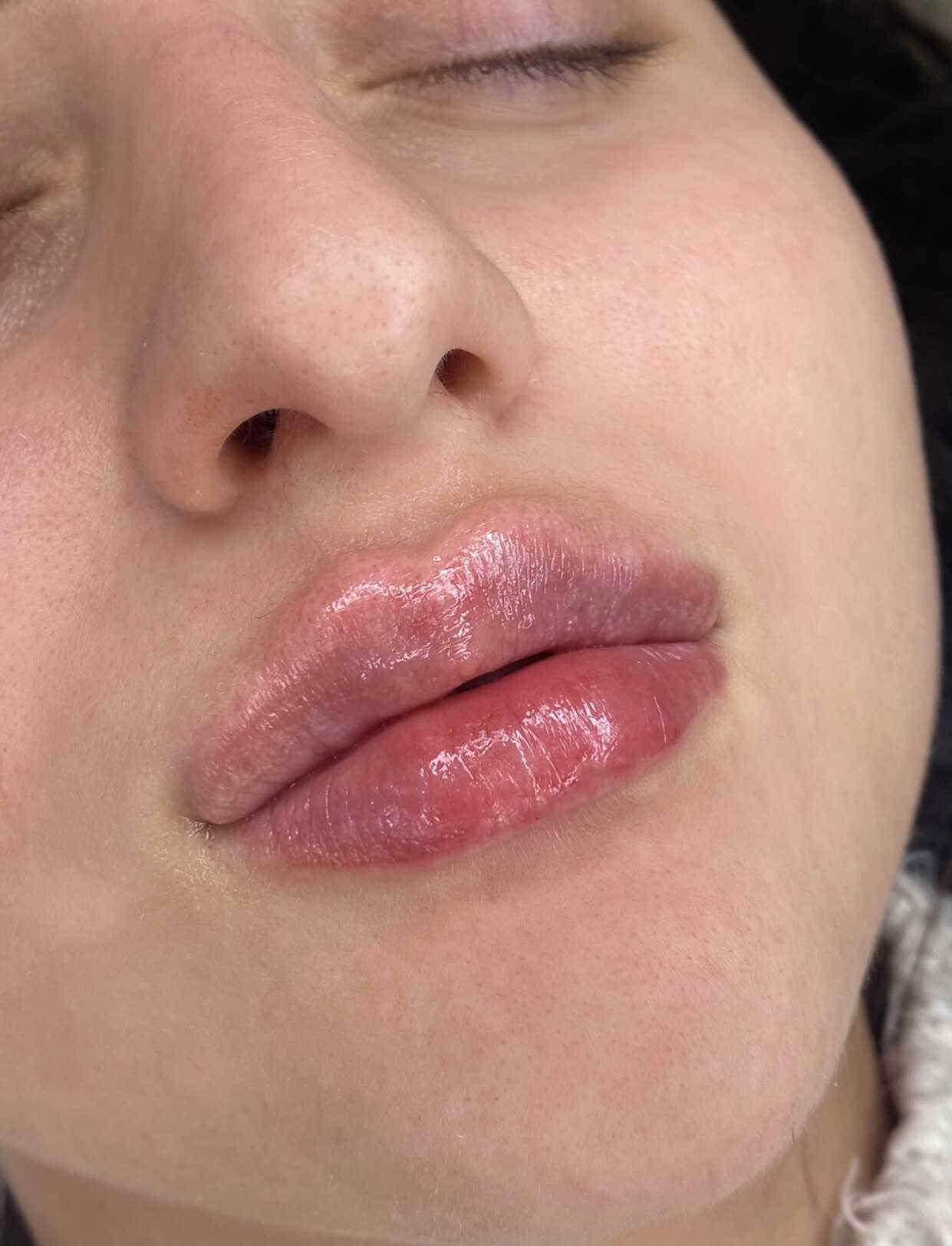 Can I Wear Lipstick After Lip Fillers